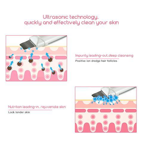 Ultrasonic Facial Cleanser – Blackhead & Acne Removal, Vibration Massager, Ultrasound Peeling Machine