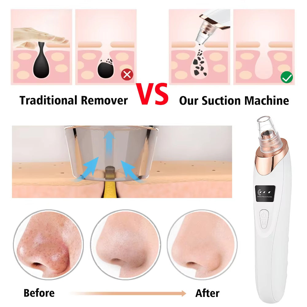 Electric Blackhead Remover – Pimple & Blemish Cleaner, Facial Skin Care Tool Kit