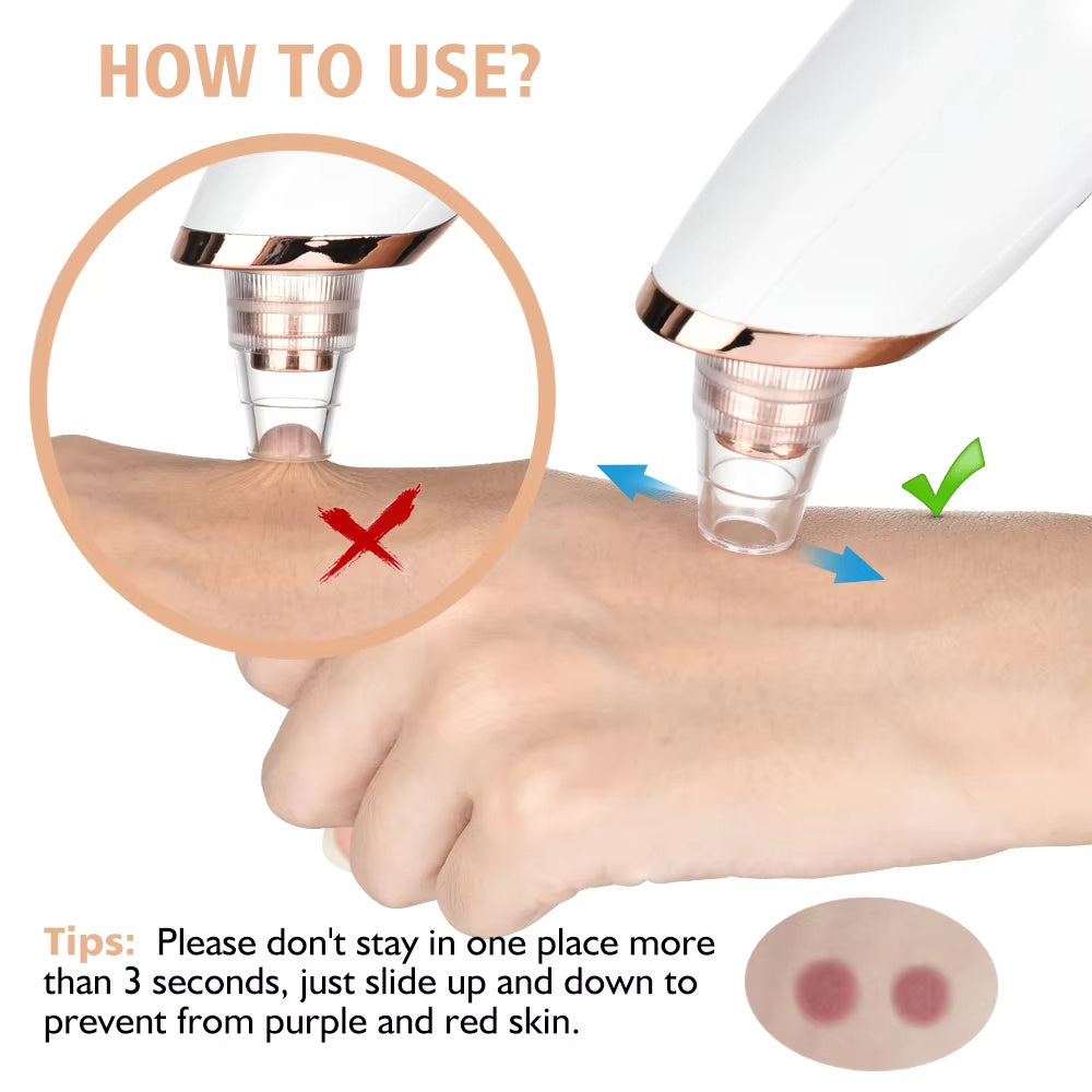 Electric Blackhead Remover – Pimple & Blemish Cleaner, Facial Skin Care Tool Kit