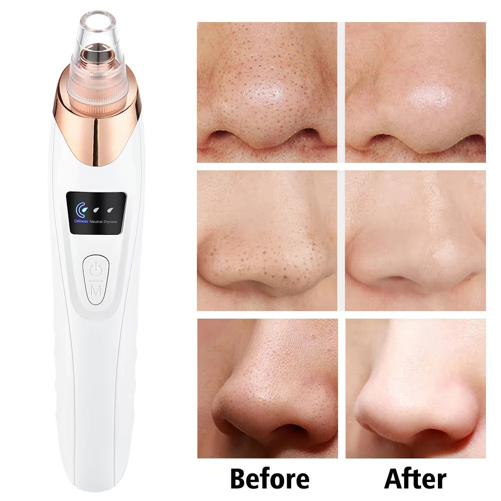 Electric Blackhead Remover – Pimple & Blemish Cleaner, Facial Skin Care Tool Kit